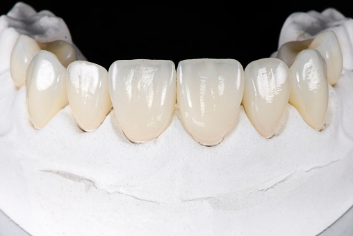 セラミックブリッジ