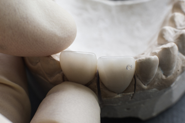 オールセラミック冠