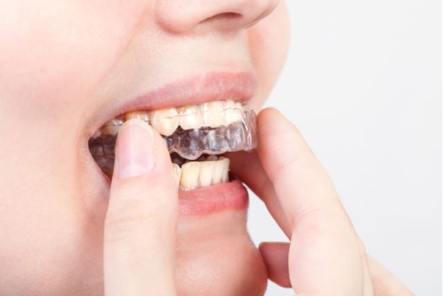 保定装置(マウスピース) 広島で「安い・人気・おすすめ」の抜かない矯正専門歯科医院