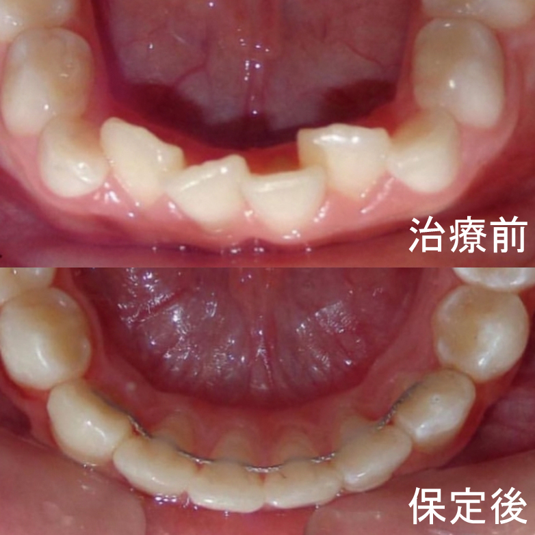 保定 広島で「安い・人気・おすすめ」の抜かない矯正専門歯科医院