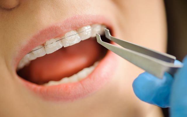 抜かない矯正装置DB 広島で「安い・人気・おすすめ」の抜かない矯正専門歯科医院