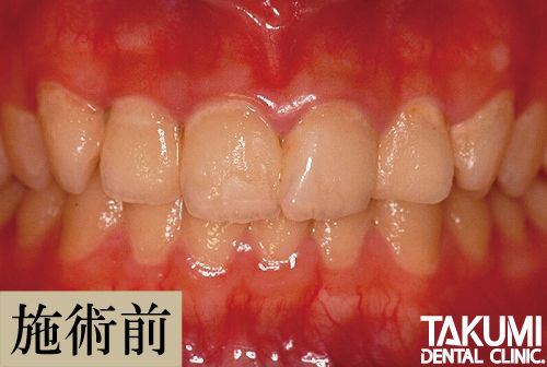 ホームホワイトニング前の歯
