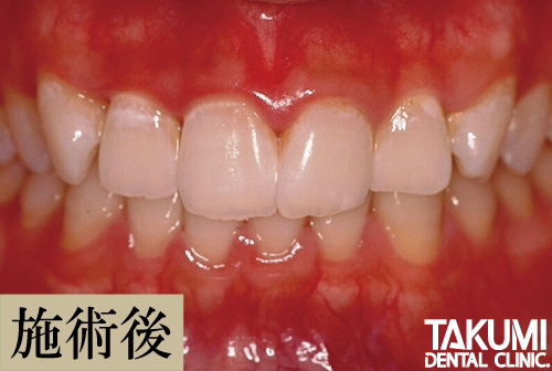 ホームホワイトニング後の歯