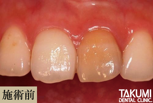 ウォーキングブリーチ前の歯