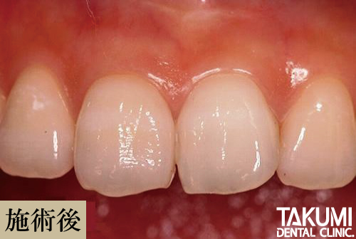 ウォーキングブリーチ後の歯