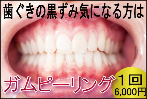 ガムピーリング＠広島で「安い・人気・おすすめ」の抜かない歯列矯正認定専門歯科