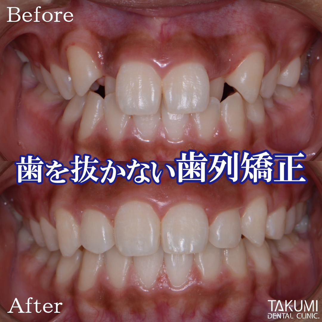 広島で「安い・人気・おすすめ」の抜かない矯正専門歯科医院 子供の矯正 子どもの矯正 小児矯正