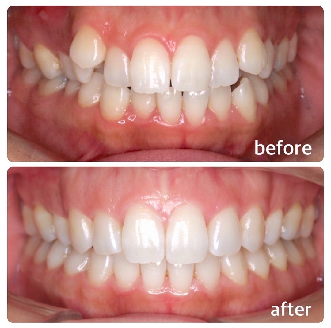 乱ぐい歯・八重歯の矯正症例 広島で「安い・人気・おすすめ」の抜かない歯列矯正認定専門歯科