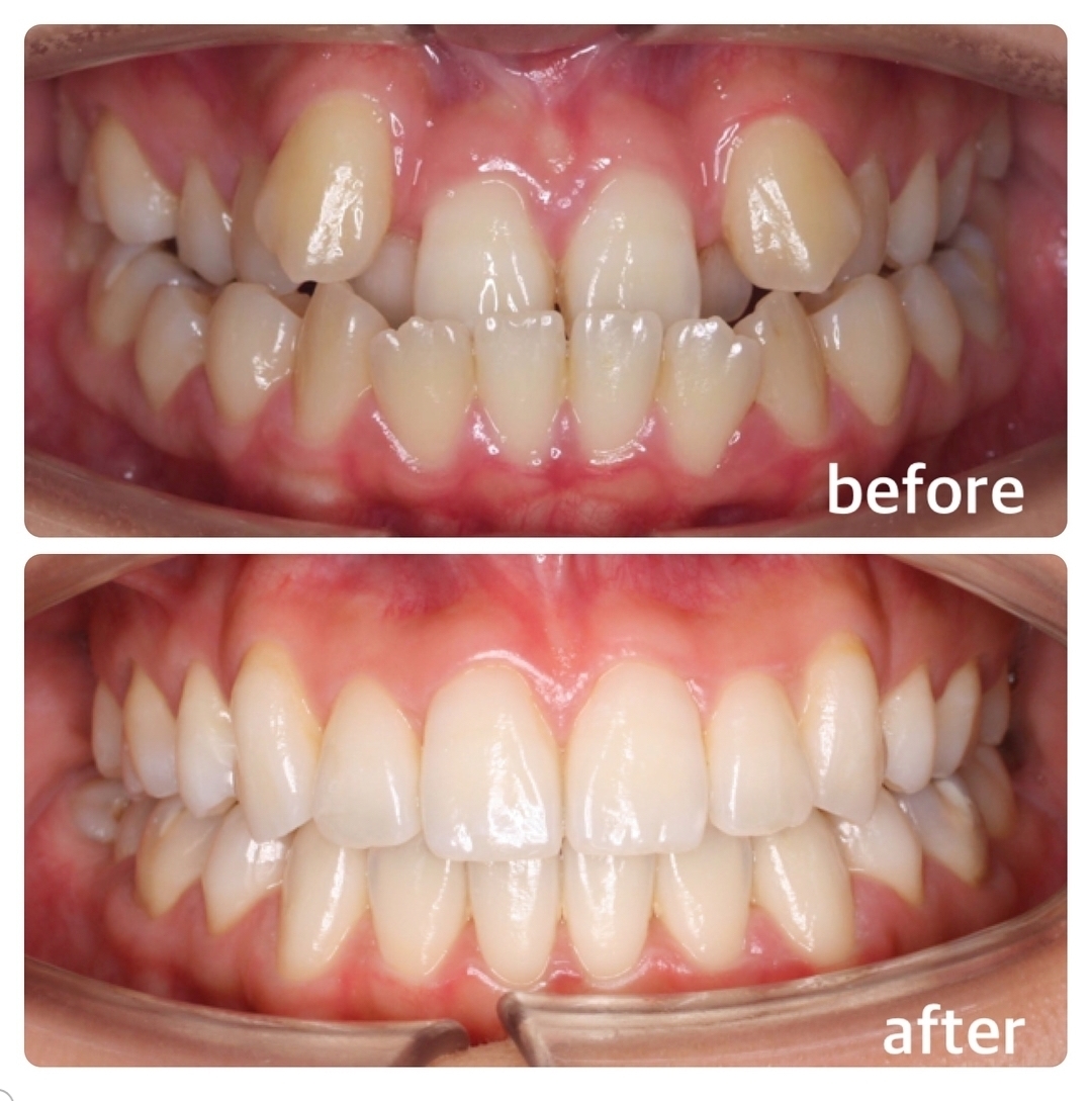 受け口の矯正症例 広島で「安い・人気・おすすめ」の抜かない歯列矯正専門歯科