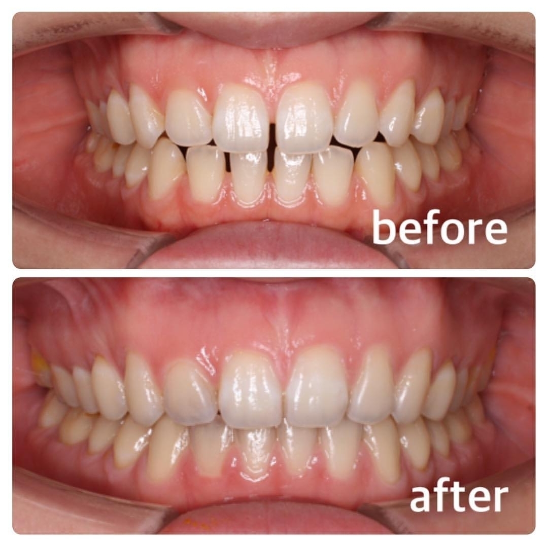 すきっ歯の矯正症例 広島で「安い・人気・おすすめ」の抜かない歯列矯正認定専門歯科