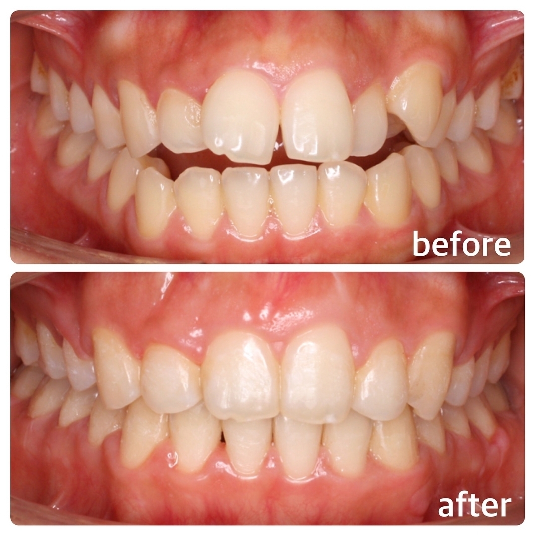 開咬の矯正症例 広島で「安い・人気・おすすめ」の抜かない歯列矯正認定専門歯科