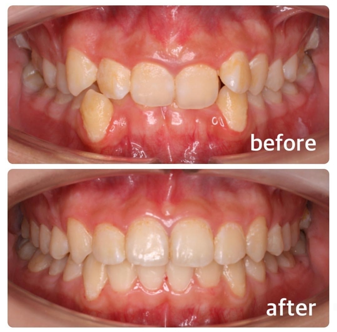 過蓋咬合の矯正症例 広島で「安い・人気・おすすめ」の抜かない歯列矯正認定専門歯科