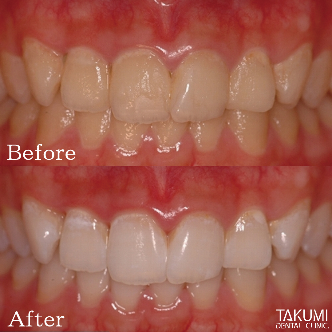 広島 ホワイトニング