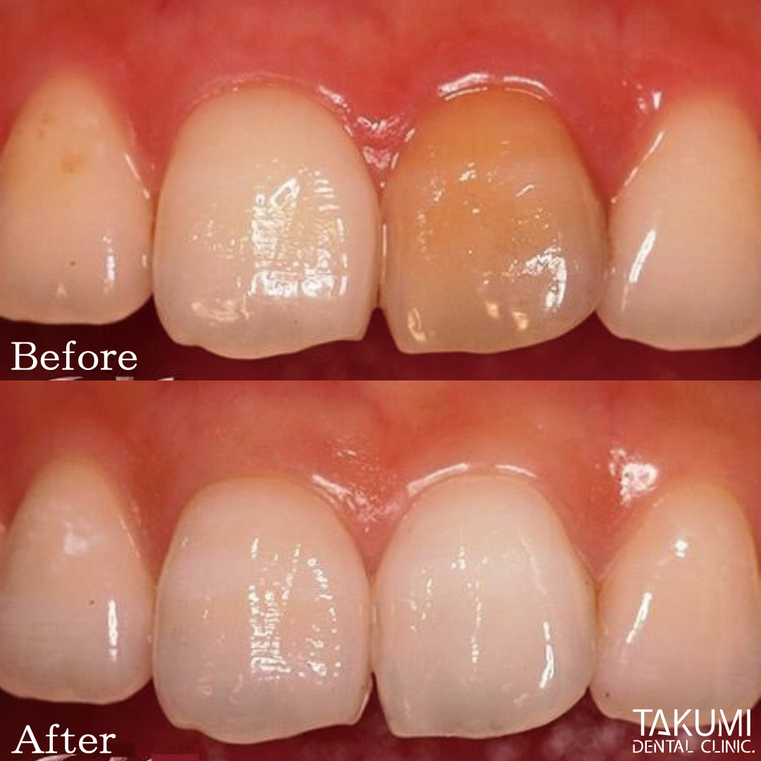 ウォーキングブリーチ 広島