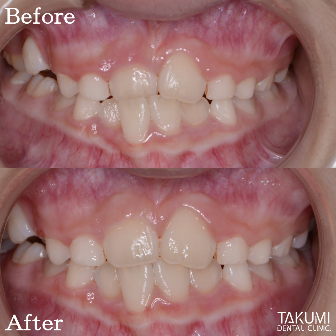 乳歯 子ども 子供 歯科 矯正 いつから マウスピース ムーシールド プレオルソ チンキャップ ヘッドギア おすすめ 人気 安い 費用 広島 矯正歯科 第1期治療 第2期治療