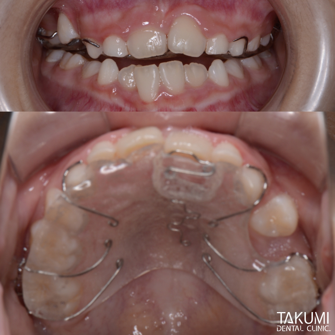 乳歯 子ども 子供 歯科 矯正 いつから マウスピース ムーシールド プレオルソ チンキャップ ヘッドギア おすすめ 人気 安い 費用 広島 矯正歯科 第1期治療 第2期治療