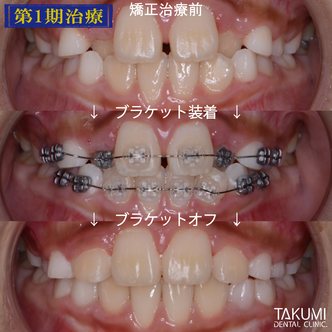 乳歯 子ども 子供 歯科 矯正 いつから マウスピース ムーシールド プレオルソ チンキャップ ヘッドギア おすすめ 人気 安い 費用 広島 矯正歯科 第1期治療 第2期治療