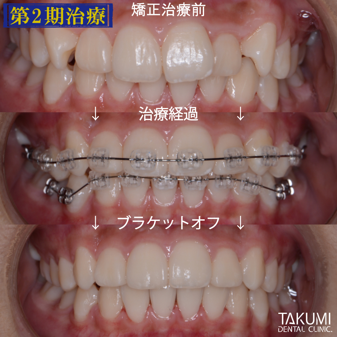 乳歯 子ども 子供 歯科 矯正 いつから マウスピース ムーシールド プレオルソ チンキャップ ヘッドギア おすすめ 人気 安い 費用 広島 矯正歯科 第1期治療 第2期治療