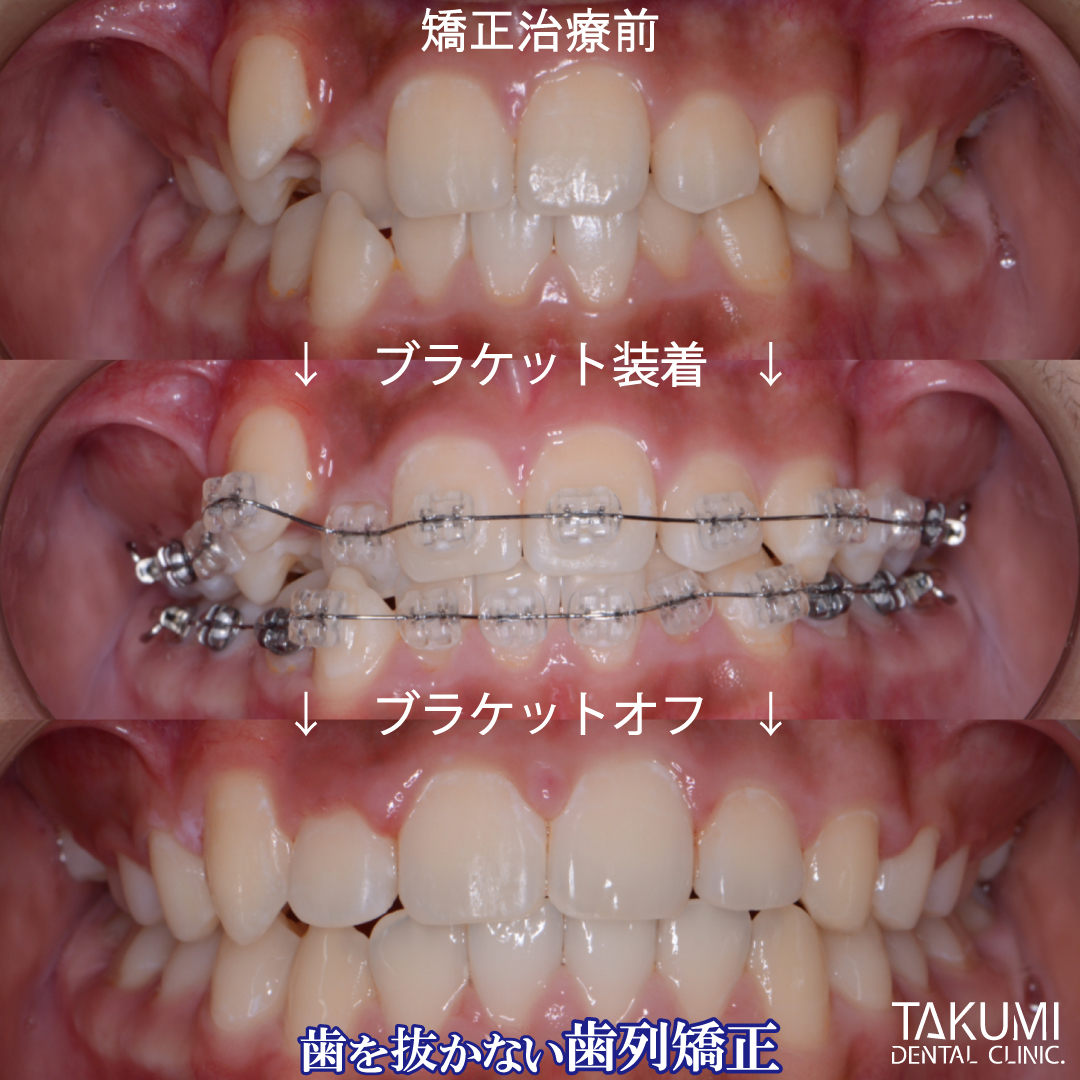 乳歯 子ども 子供 歯科 矯正 いつから マウスピース ムーシールド プレオルソ チンキャップ ヘッドギア おすすめ 人気 安い 費用 広島 矯正歯科 第1期治療 第2期治療